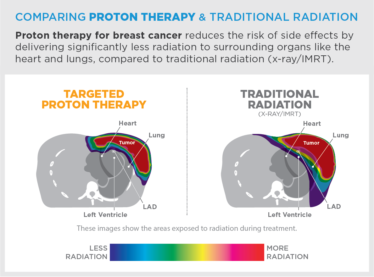 Proton therapy for breast cancer reduces the risk of side effects by delivering significantly less radiation to surrounding organs like the heart and lungs, compared to traditional radiation (x-ray/IMRT).