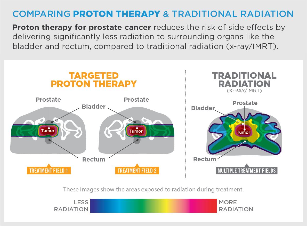 Can radiation therapy cure prostate cancer